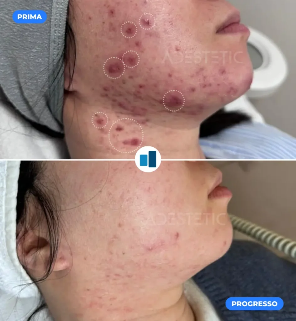 Before and after images showing the improvement in skin clarity from acne treatment.