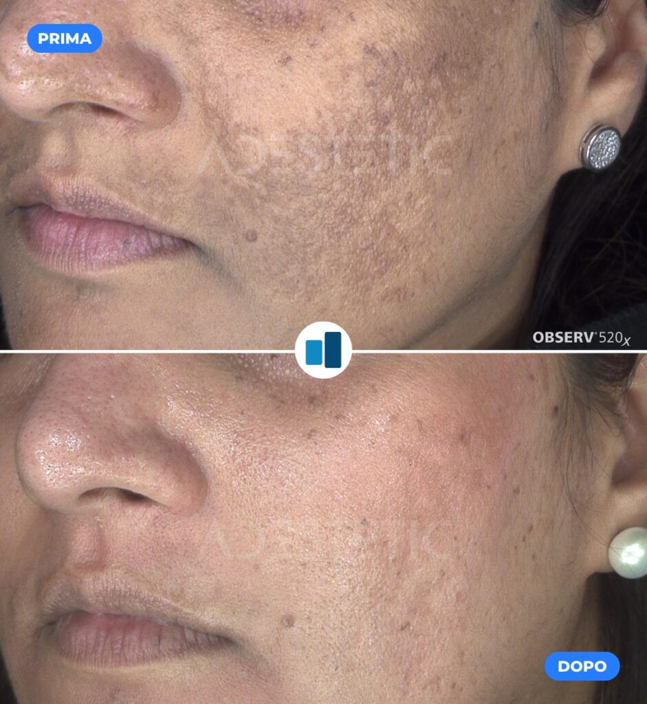 MelanReset® before & after: Skin with pigmentation, then clearer skin after treatment.