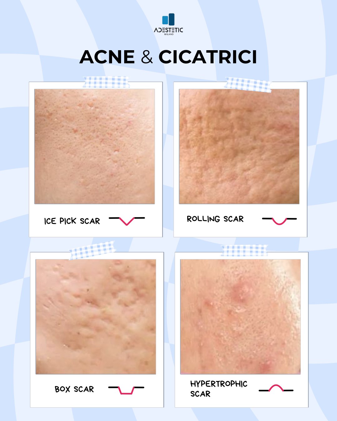Acne scars types: ice pick, rolling, box, and hypertrophic scars. Skin texture close-up.