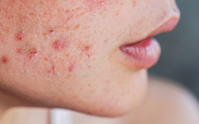 A woman's face with visible acne, highlighting the focus of an acne bootcamp program.