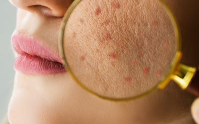 Valutazione iniziale per il trattamento dell'acne