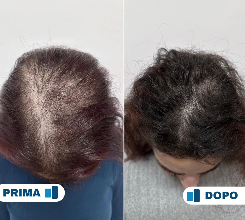 Before and after hair growth treatment. Woman's scalp showing hair loss and improved hair density.