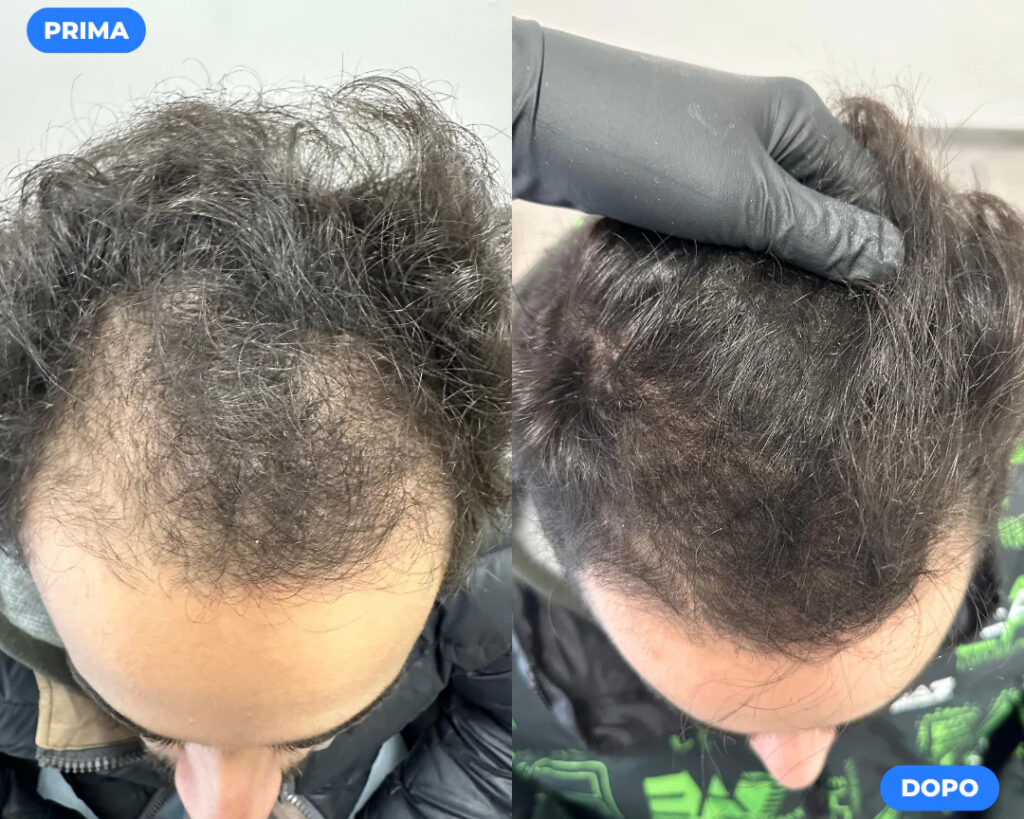 Prima e dopo trattamento laser