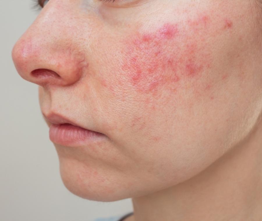 Acne