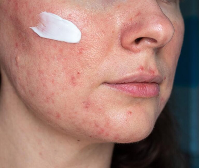 Cicatrici da acne